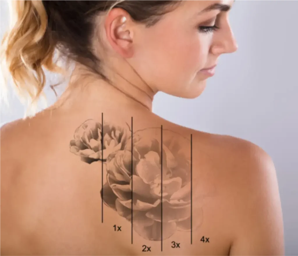 Laser Tattoo Removal
