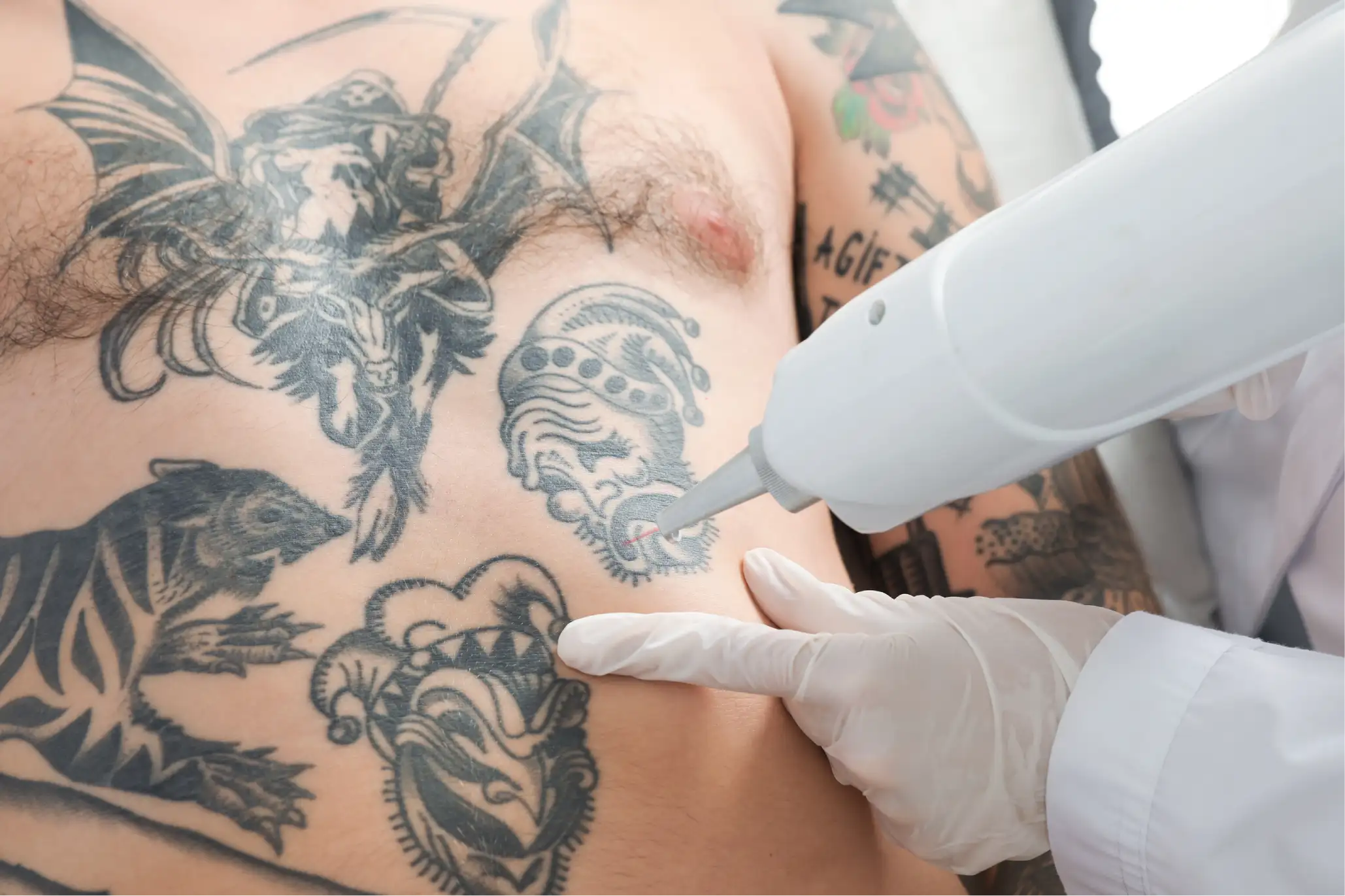 Inkless Tattoo Removal